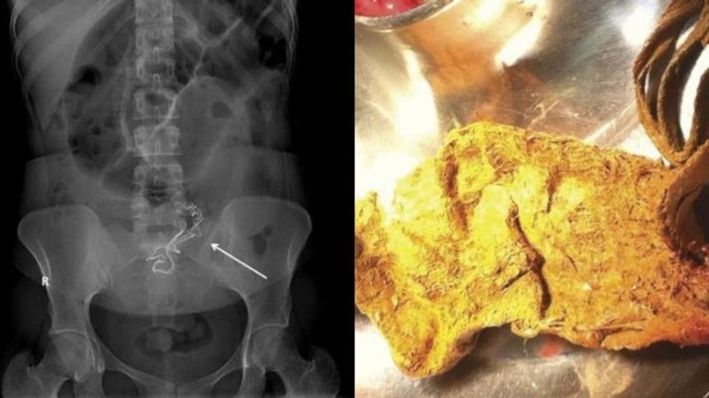 20대 女, 변비 시달리다…장에서 '이것' 발견 경악 [헬스톡]