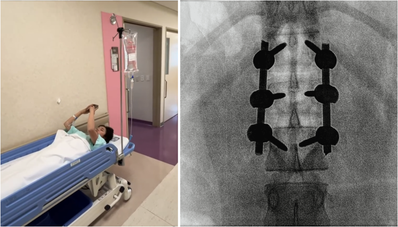 2024년 당시 척추 골절로 수술을 받은 최가온의 모습이 온라인에서 공유됐다. /사진=온라인 커뮤니티 캡처