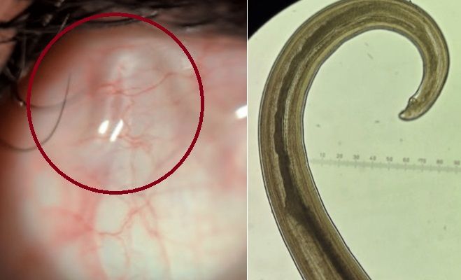 눈 흰자 안에서 움직이고 있는 기생충의 모습(왼쪽 사진 붉은색 원 안), 오른쪽은 험실 현미경으로 관찰한 수컷 로아로아 벌레. 출처=큐레우스(Cureus)