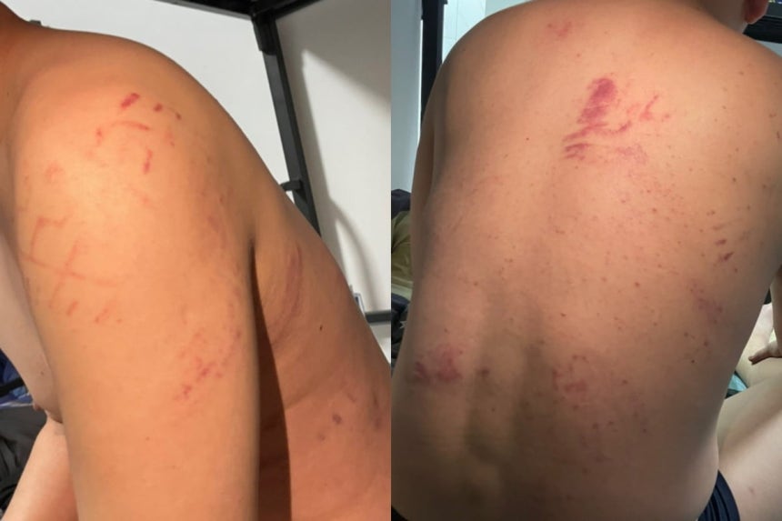 캄보디아 포이펫에 있는 한 사기 콜센터에서 한국인이 폭행을 당해 온몸에 붉은 멍 자국이 남아 있다. /사진=독자 제공