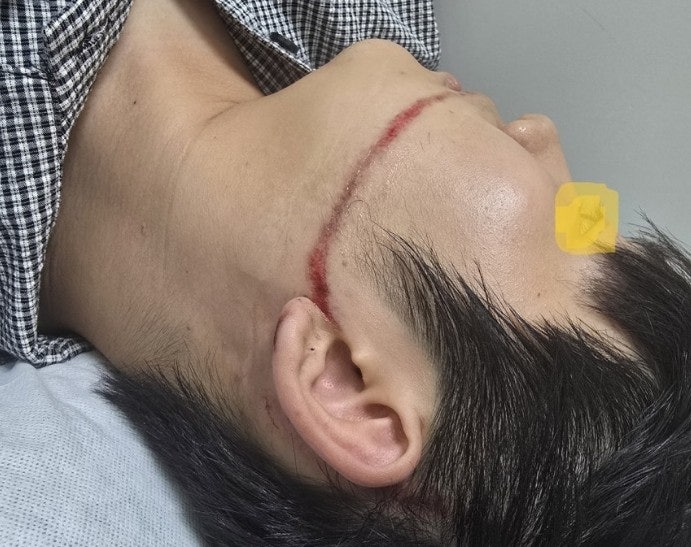 <b>물 축제</b>서 <b>워터건</b> 맞아 얼굴 50 봉합한 대학생…주최 측 고소