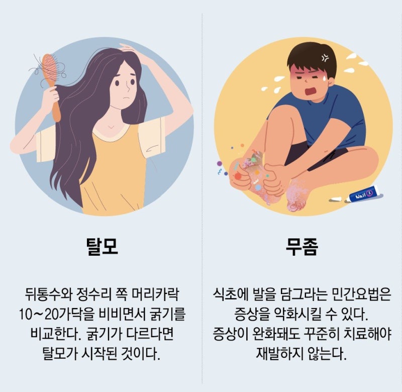 무좀, 발에만 나타나?… 겨드랑이-얼굴도 조심[브레인 아카데미 플러스]