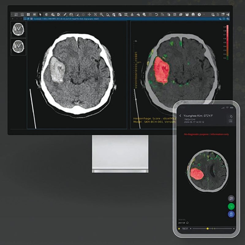 퍼플에이아이, 뇌졸중 진단 ‘3종 인공지능’ 포트폴리오 완성 [헬스케어 소식]
