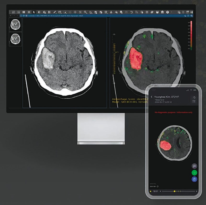 퍼플에이아이의 AI 솔루션은 비조영 컴퓨터단층촬영(CT) 영상에서 병변을 자동 탐지해 의료진의 판독 시간을 획기적으로 단축한다. 퍼플에이아이 제공