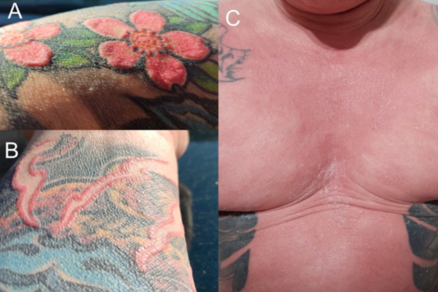 36세 남성이 붉은색 문신 시술 후 전신 홍피증,탈모,백반증 및 땀샘 파괴에 따른 무한증 등 심각한 전신 부작용을 겪었다.사진=Clinics and Practice