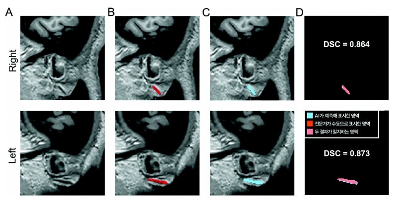 귓불의 사선 주름 ‘프랭크 징후’와 심뇌혈관질환 연관성 밝혀졌다