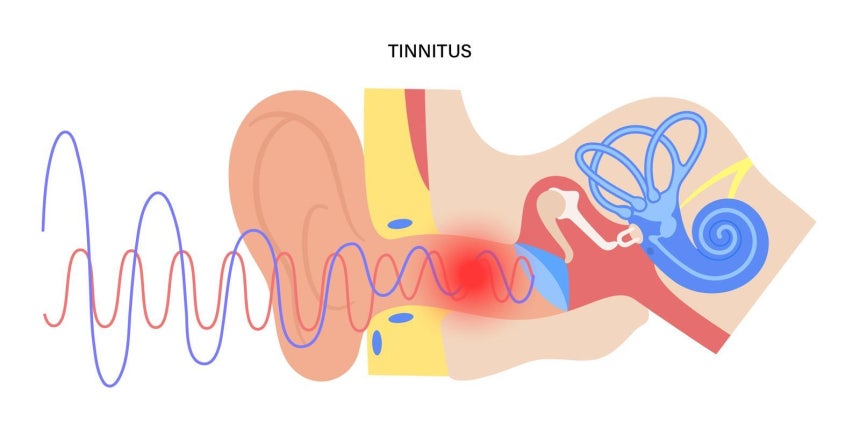 이명은 하나의 질환이 아니라 증상에 가깝다.난청,소음 노출,스트레스,혈관성 이상 등 다양한 원인이 관여할 수 있어 전문의의 감별 진료가 중요하다. 게티이미지뱅크