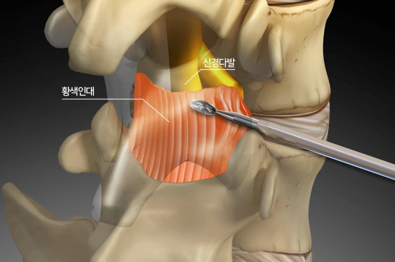 “추간공확장술, 시술 직후 ‘골든타임 72시간’이 성패 가른다”