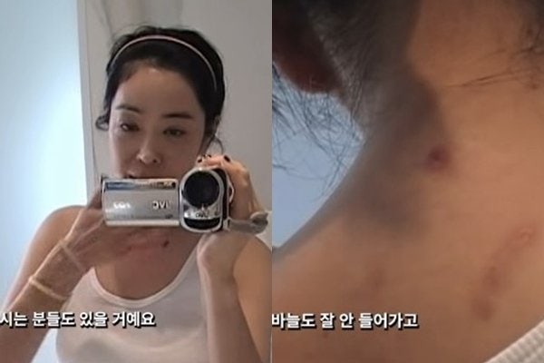 폐암 투병 <b>이혜영</b> “곳곳에 수술 흉터…이겨내고 세상 나올 것”
