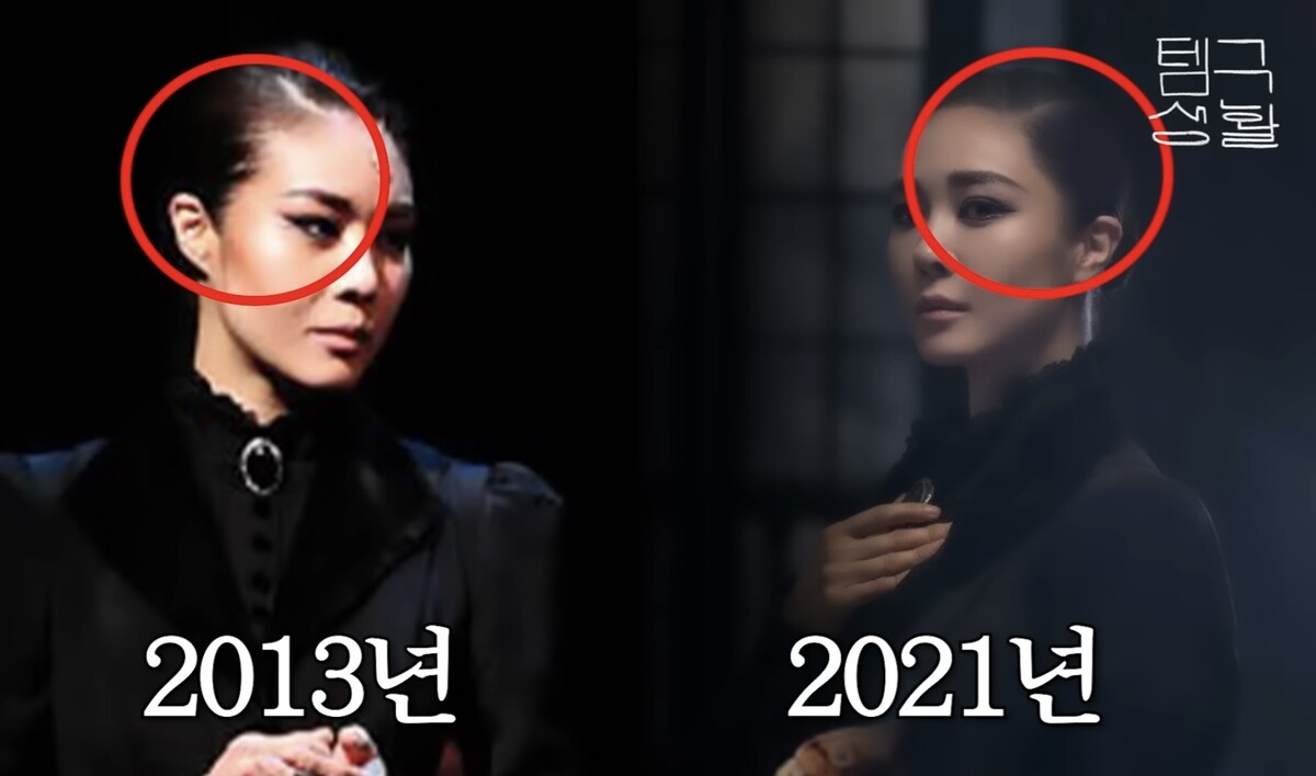 <b>옥주현</b>, 탈모·<b>모발 이식</b> 후 <b>스트레스</b> 폭발…“억만금 줘도 안 돼” 전...