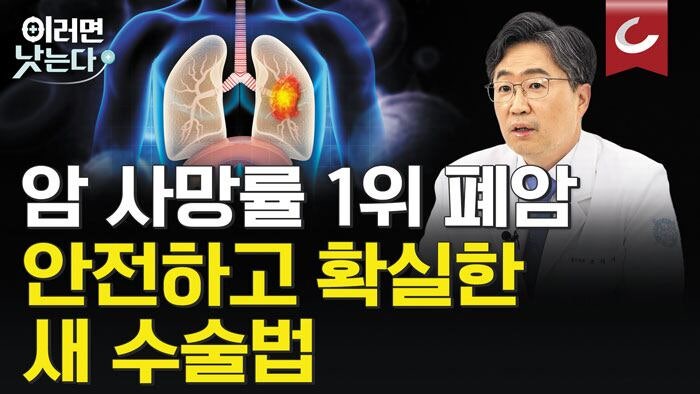 ‘폐암 싹’ 간유리 음영 결절, 폐 일부만 잘라 제거