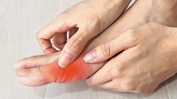 ‘치맥’의 계절, 고통 커지는 통풍…연중 7월 환자 가장 많아
