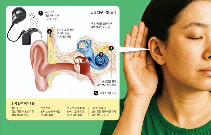보청기도 소용없는 노인성 난청… 인공와우로 청력 회춘