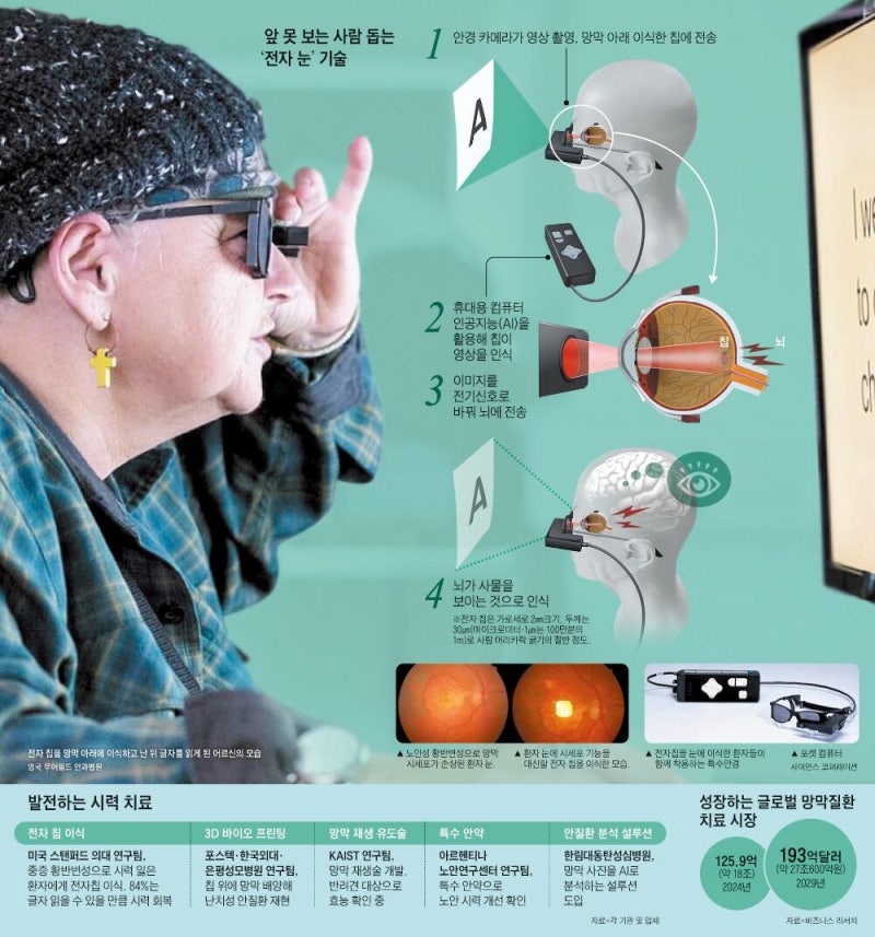 눈에 전자 칩 심어 시력 되찾는다
