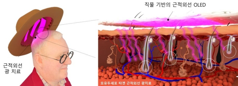 탈모 예방 모자 개발... “모낭 세포 노화 92% 억제”