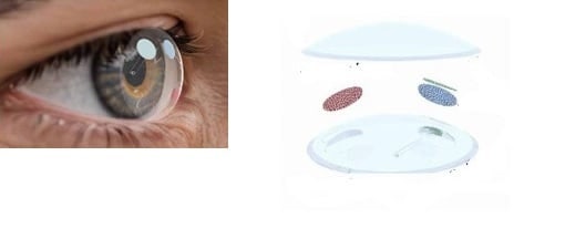안압 오르면 약물 나와… 녹내장 관리 렌즈 개발