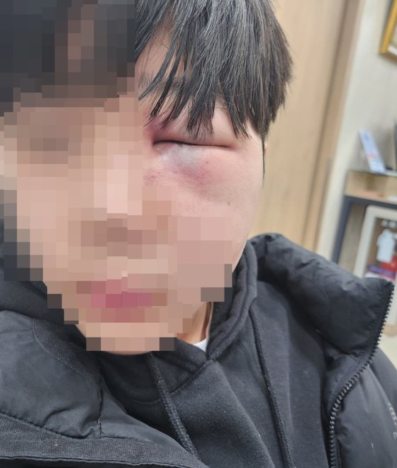 폭행으로 망막이 훼손된 학생 얼굴. 연합뉴스