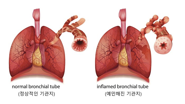 소아 천식 환자의 기관지 비교.자료 서울대병원
