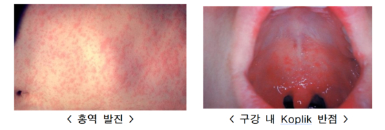 홍역 증상은 초기에 감기처럼 기침,콧물,결막염 등이 나타나고,고열과 함께 온몸에 발진이 나타난다.사진 미국질병관리본부,질병관리청