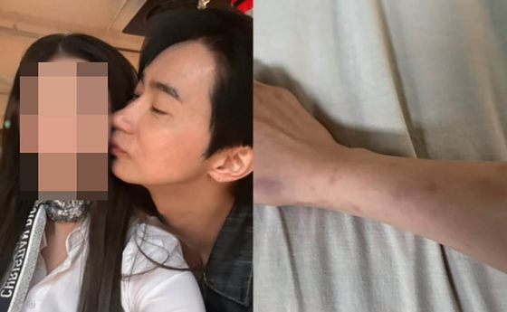 A씨가 24일 인스타그램에 올린 전호준과 함께 찍은 사진과 멍이 든 신체 사진. A씨 인스타그램 캡처