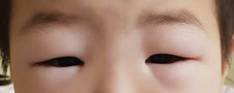 스테로이드로 버티던 아동들, 희귀 신장병 'K지침' 나왔다