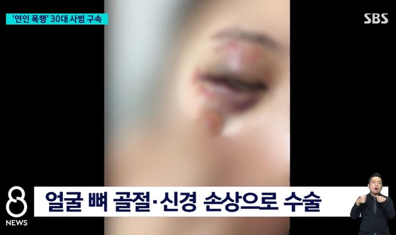 경기 고양시 일산동구 길에서 30대 태권도 사범이 여자친구의 얼굴을 발로 차는 등 폭행한 혐의로 30일 구속됐다. 피해 여성은 A씨의 폭행으로 얼굴 뼈가 부러지고 신경이 손상돼 수술을 받았다고 SBS는 전했다. 사진