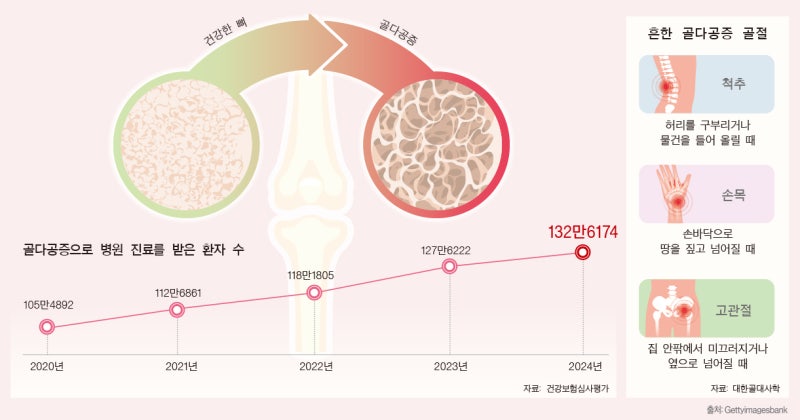 소리 없이 찾아오는 골다공증, 키 줄고 허리 굽어지는 게 단서 [Health&]