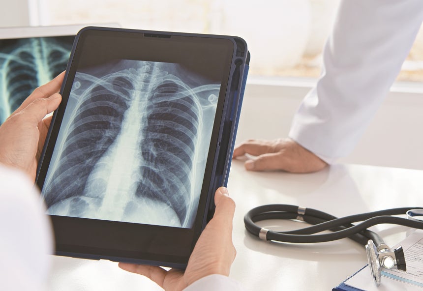 초기 증상이 거의 없는 폐암은 흉부 X선 검사와 저선량 흉부 CT를 통해 조기에 발견하는 것이 바람직하다.