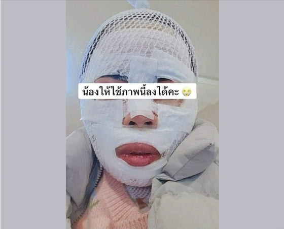 한국인 40대 남편 A씨가 끓는 물을 얼굴에 부어 화상 입은 태국인 아내 B씨.사진 페이스북 캡처