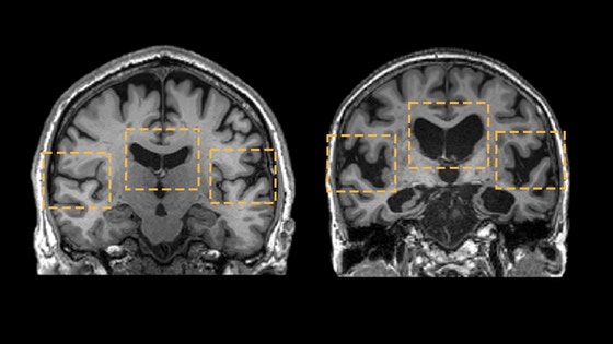 중년을 어떻게 보내느냐에 따라 당신의 뇌는 치매에 부쩍 다가설 수도 있고,한없이 미룰 수도 있다.치매 관리의 핵심 시기는 중년이다.부피가 충분해 보이는 오른쪽 뇌는 정상인.쪼그라들어 휑해 보이는 왼쪽 뇌는 알