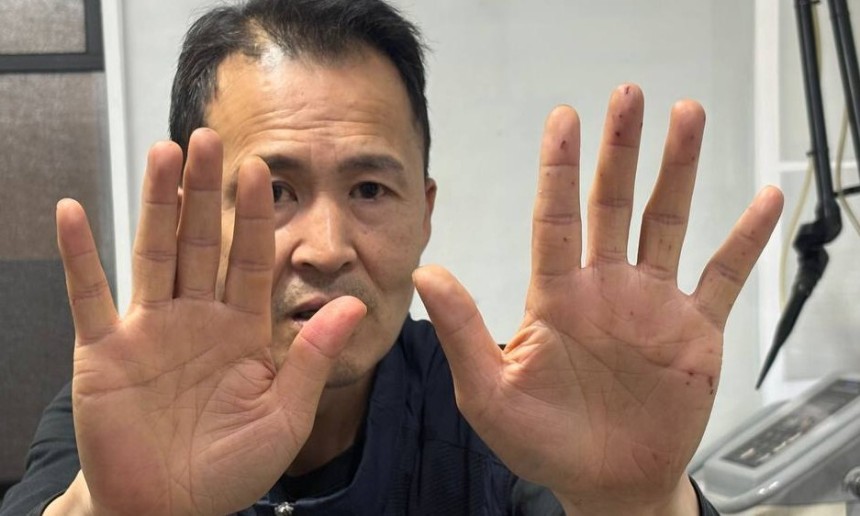 지난 11일 서울 한강대교 위에서 고공농성한 송준영(55)씨가 12일 한겨레와 만나 한강대교 아치를 올라가며 손에 박힌 쇠 가시들을 보여주고 있다. 이나영 기자