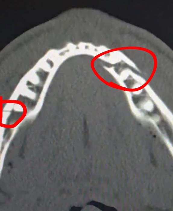 유튜버출신 복서 제이크 폴이 앤서니 조슈와의 경기로 턱뼈 부상을 입었다.사진=인스타그램 캡처
