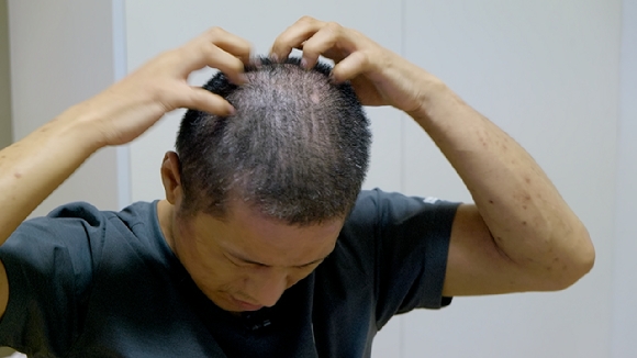 오는 13일 밤 9시 50분에 방송되는 EBS '귀하신 몸' '지긋지긋한 가려움과 비듬. 내 두피에 무슨 일이?' 편에서는 두피 질환에 대한 모든 것을 파헤치는 시간을 가진다. [사진=EBS]