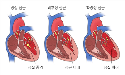 심근병증은 다양한 유형으로 나타나며 크게 분류해 심장근육이 두꺼워지는 비후성 심근과 심실이 확장돼 늘어지는 확장성 심근으로 나뉜다.서울아산병원 제공
