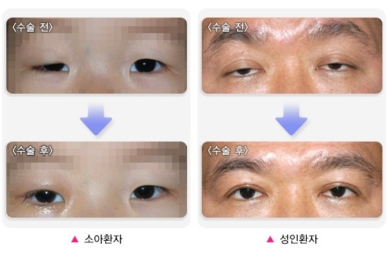 안검하수가 생겼다면 수술로 위아래 눈꺼풀 사이 간격을 넓힐 수 있다.국가건강정보포털