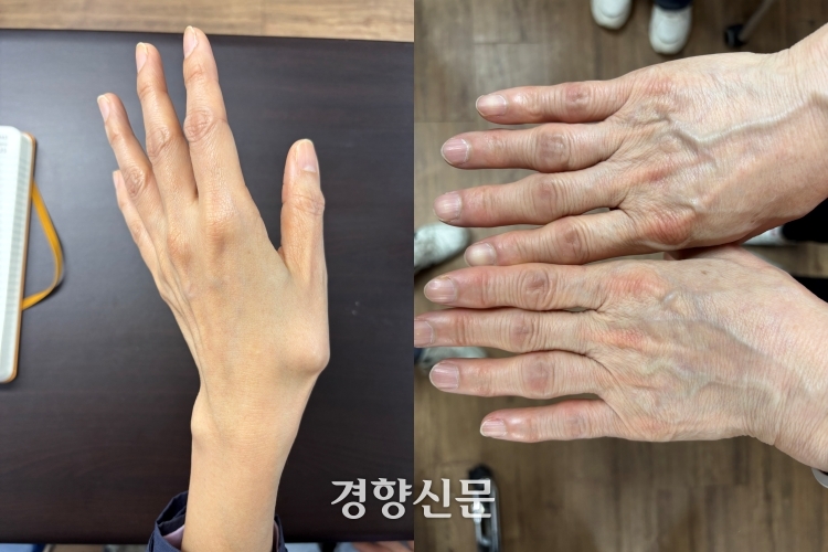 대전 글꽃중학교 조리사의 손. 식판을 닦는 등의 반복 작업으로 왼손 엄지손가락의 연골이 닳아 뼈가 튀어나와 있다.(왼쪽) 대전 둔산여고 조리사의 손. 반복 작업으로 연골이 닳으면 뼈가 뼈끼리 부딪치고 염증이 생기면서