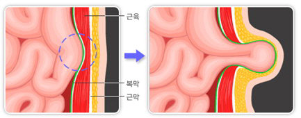 복벽의 약해진 근막·근육 부위로 내장이 밀려 나옴| 탈장의 발생 기전 자료 : 국가건강정보포털