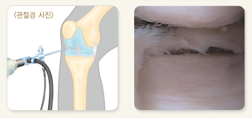 퇴행성 골관절염 환자의 무릎 관절을 관절경으로 관찰하면 연골이 손상된 모습을 볼 수 있다.국가건강정보포털