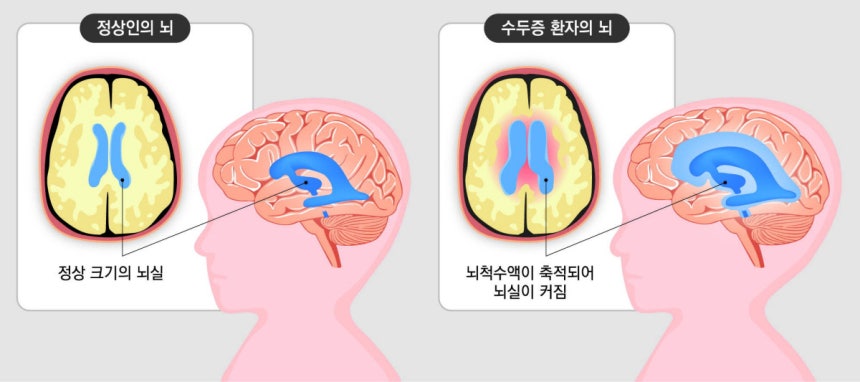 수두증 환자는 뇌에 뇌척수액이 과도하게 차 있는 양상이 나타난다.자료: 보건복지부