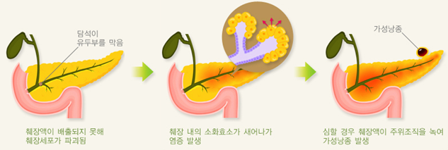 담석이 급성 췌장염을 일으키는 과정의 모식도.국가건강정보포털