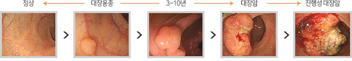 고통스런 내시경에 대변 체취, 안해도 된다?···“대장암 진단, 피만 뽑아도 정확도 높아”
