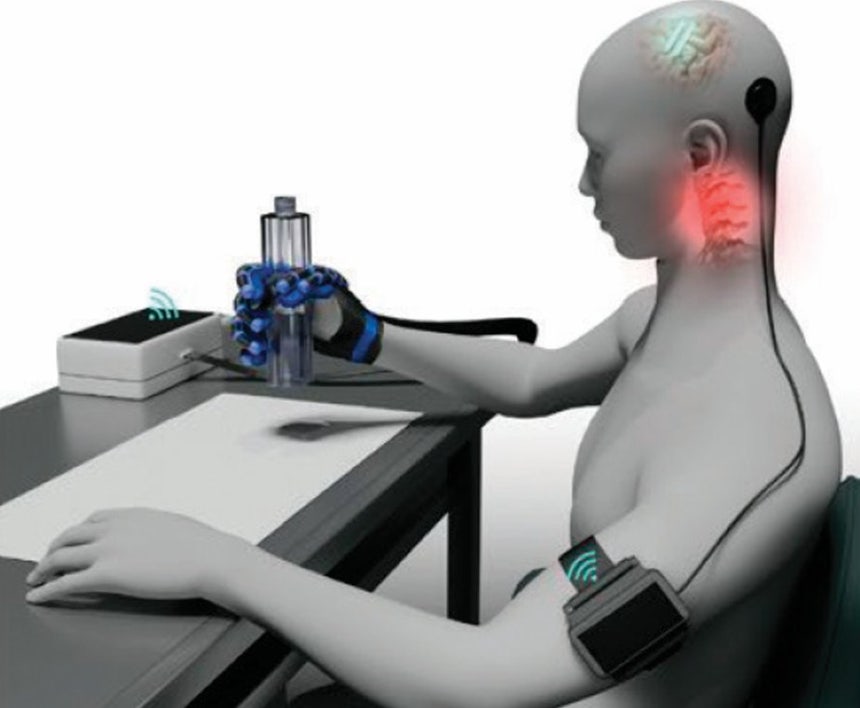 중국 기업 뉴라클이 개발한 뇌-컴퓨터 인터페이스(BCI) 장치 ‘네오(NEO)’. 사지마비 환자 머리에 심은 칩이 뇌 신호 데이터를 분석해 장갑 형태의 로봇손으로 전달한다. 로봇손을 착용한 환자는 원하는 대로 손을 