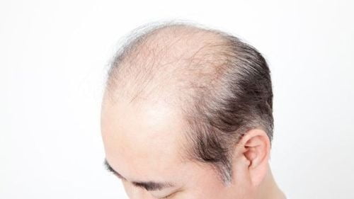 탈모 사진 / 나만의 닥터