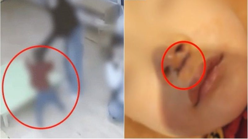 <b>교사</b>가 4살 아이 내팽개쳐 여섯 바늘 꿰매…<b>어린이집</b>은 버젓이 "운영 중...
