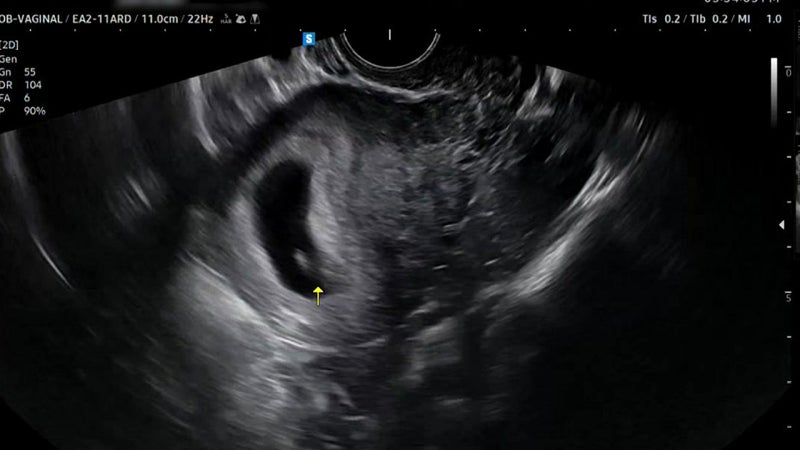 멀쩡한 아기, 의사 오진으로 긁어내라?! 😱