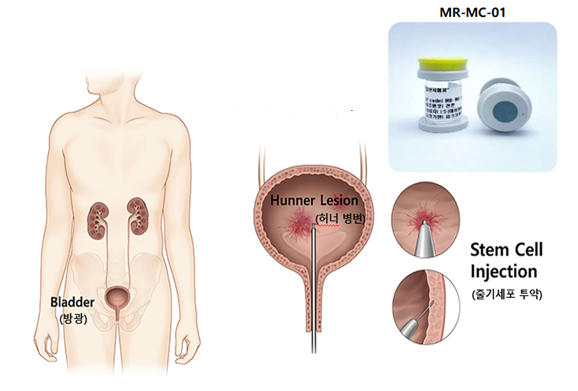줄기세포 치료제(MR-MC-01)를 이용한 간질성 방광염 1/2a 임상시험 요약