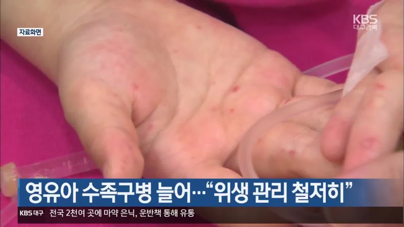 영유아 수족구병 늘어…“위생 관리 철저히”