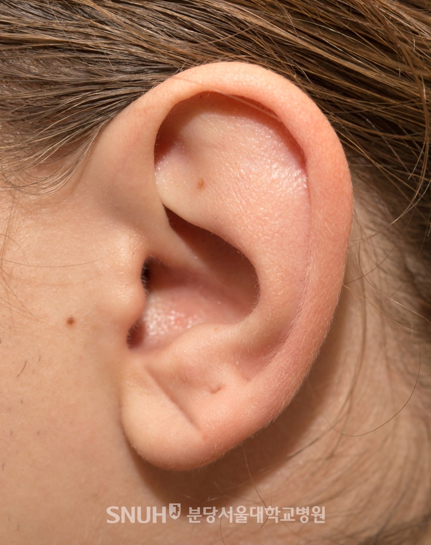 귓불에 주름 있으면 뇌혈관 확인해봐!