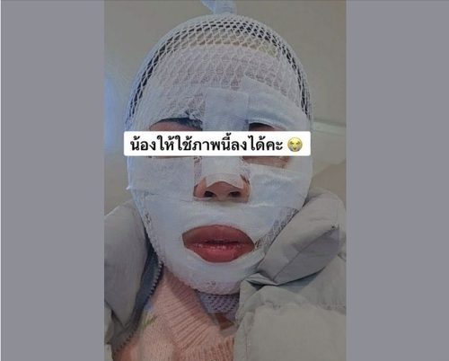 화상 입은 태국인 아내 / 사진=페이스북 캡처 
