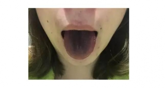 훠궈를 먹은 뒤 혓바닥이 검게 변하는 현상을 겪은 사람들의 경험담이 올라오고 있다.사진 출처 웨이보